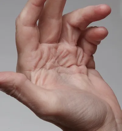 DUPUYTREN KONTRAKTÜRÜ (PALMAR FİBROZİS)