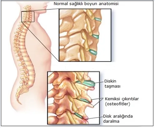 BOYUN FITIĞI (SEVİCAL DİSK HERNİ) 