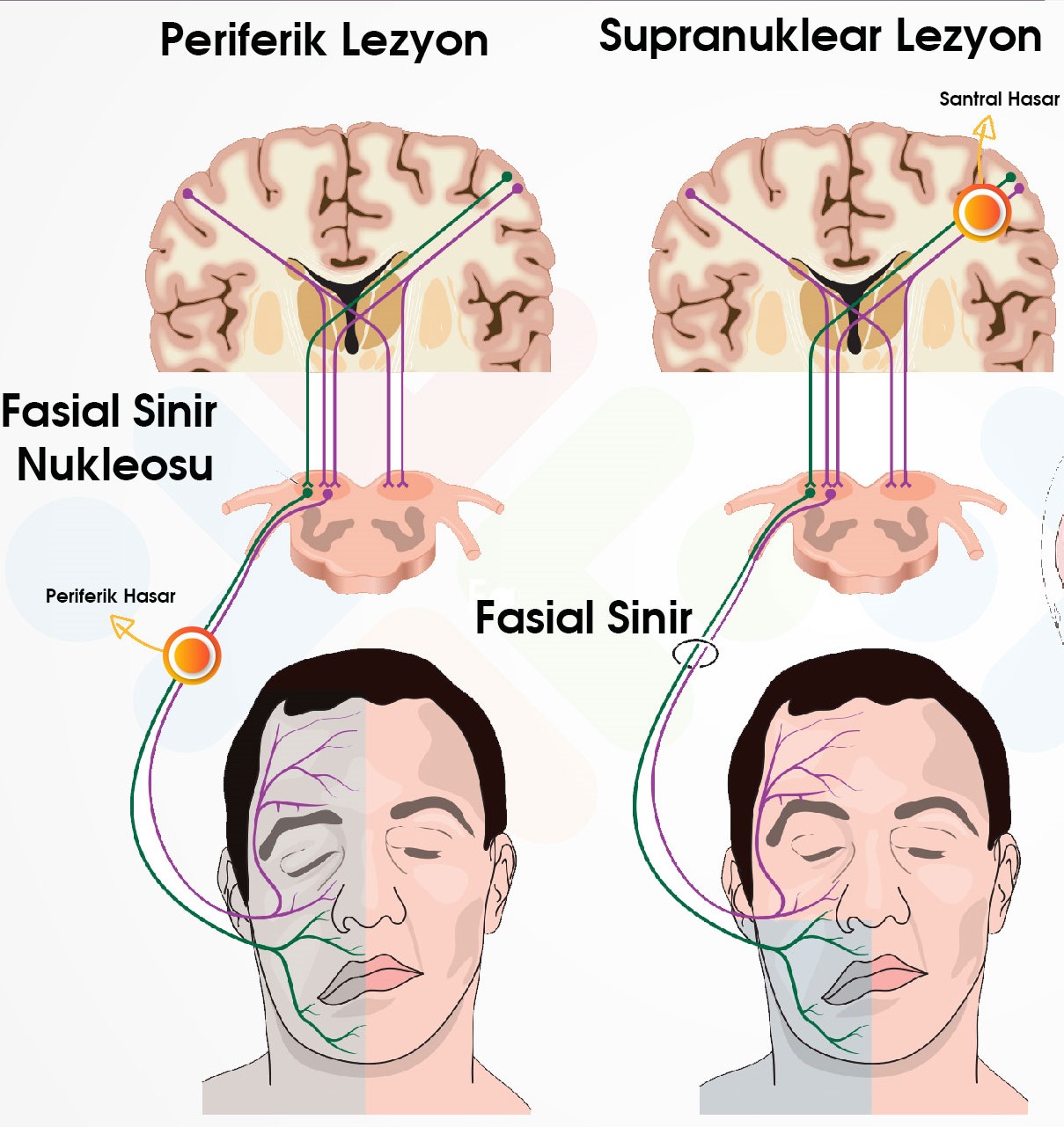 YÜZ FELCİ(FASİAL PARALİZİ) NEDİR? NEDENLERİ VE B