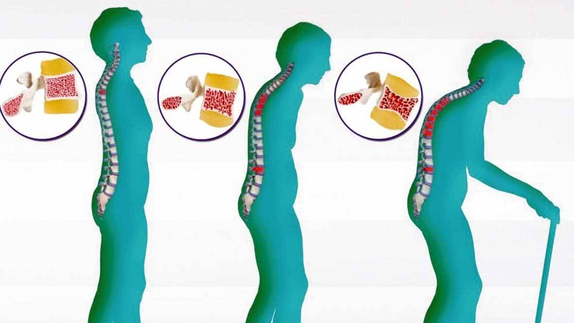 KEMİK ERİMESİ (OSTEOPOROZ) 