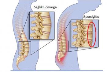 ANKİLOZAN SPONDİLİT (AS)