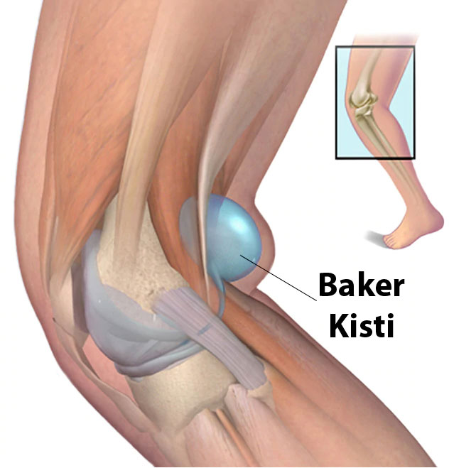 BAKER KİSTİ (DİZ ARKASI AĞRISI) 
