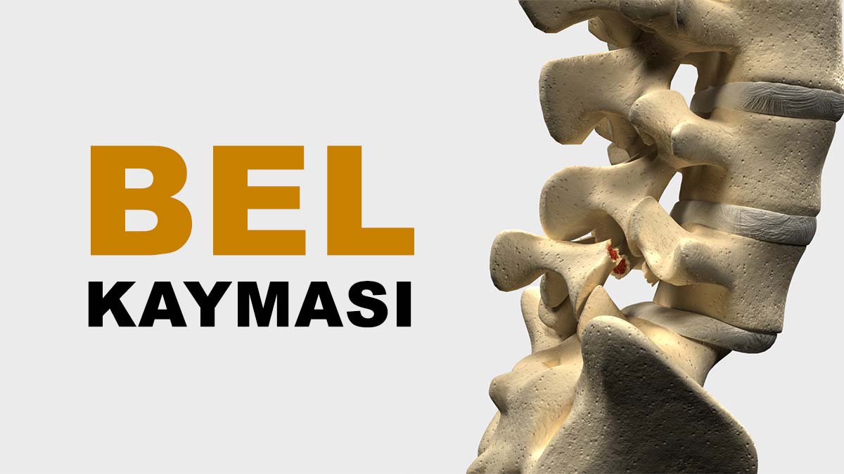 BEL KAYMASI (Spondilolistezis) NEDİR?
