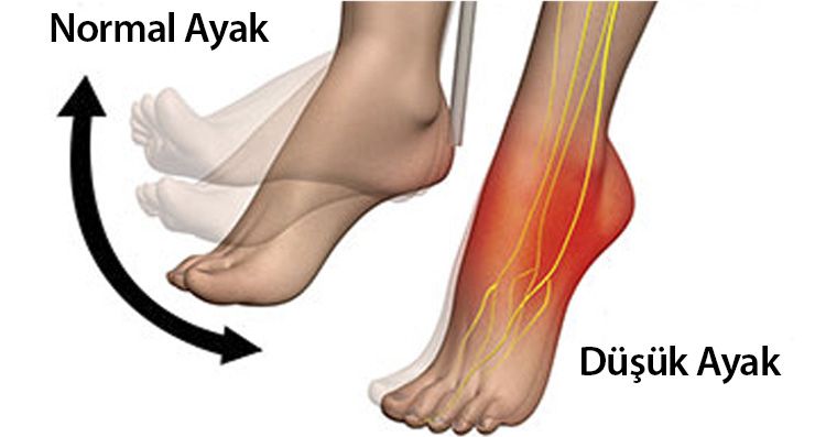 DÜŞÜK AYAK SENDROMU