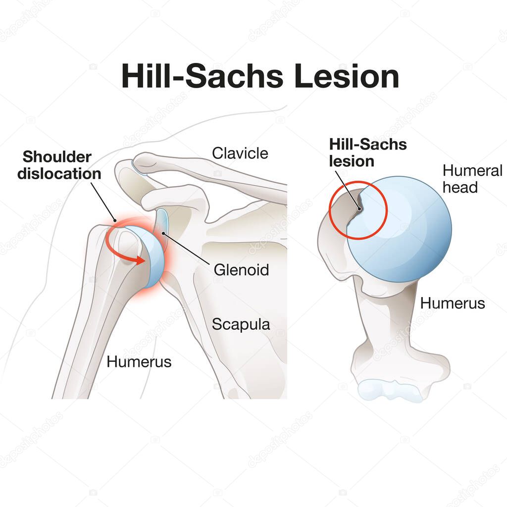 Hill Sachs Lezyonu Nedir?