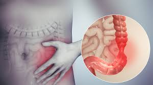 İrritabl Barsak Sendromu (İBS) ve Düşük FODMAP Diy