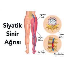 SİYATİK AĞRISI (SİYATALJİ) NEDİR?