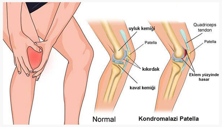 Kondromalazi Patella (Koşucu Dizi) 