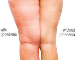 LİPÖDEM BESLENMESİ