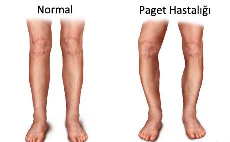 PAGET HASTALIĞI 