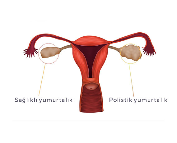 POLİKİSTİK OVER SENDROMU VE BESLENME