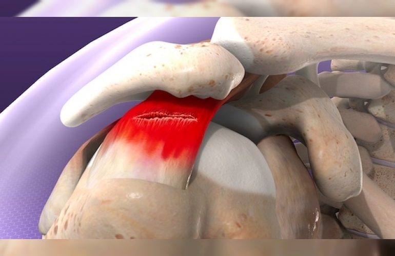 ROTATOR CUFF (MANŞET) SENDROMU 