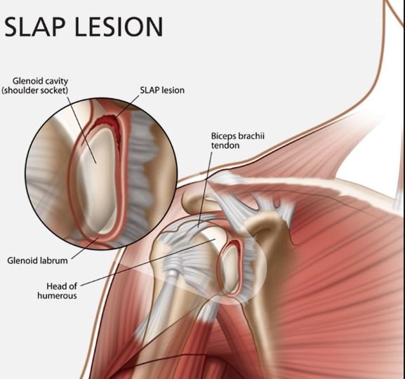SLAP LEZYONU