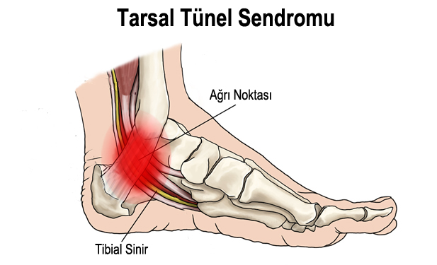 TARSAL TÜNEL SENDROMU (TTS)