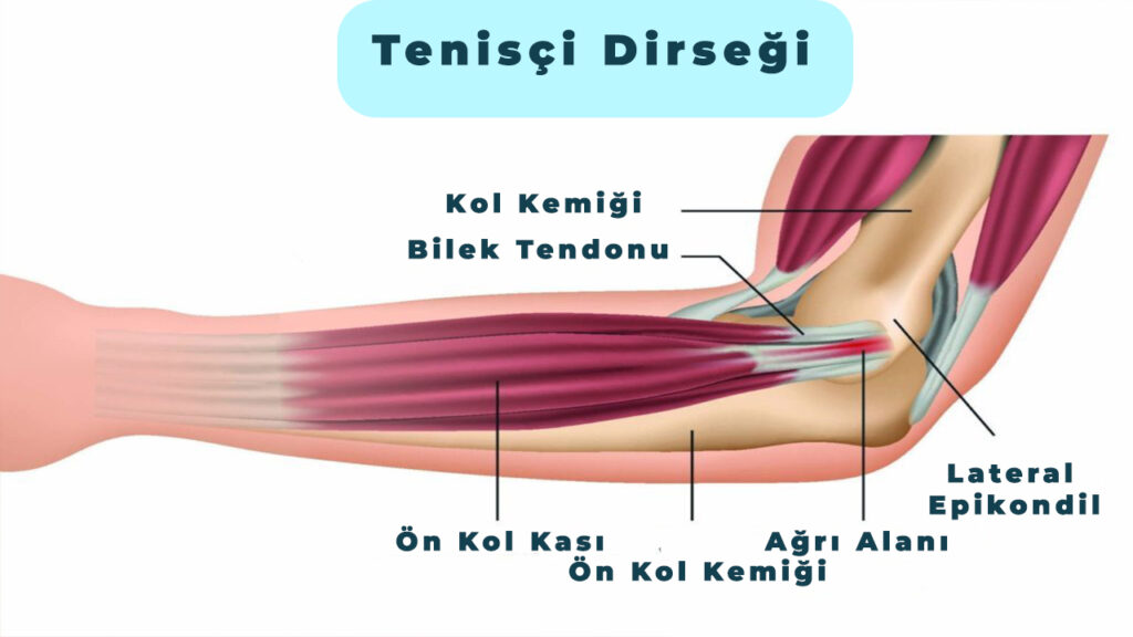 TENİSÇİ DİRSEĞİ (LATERAL EPİKONDİLİT) NEDİR?