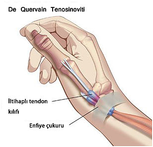 De Quervain Tenosinovit